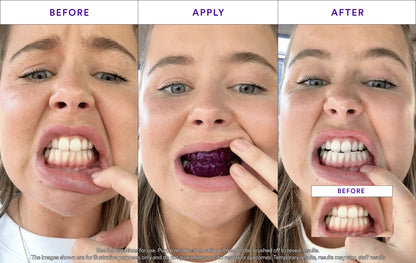 💎V34 Whitening Strips-Purple Tooth Whitening, Tooth Stain Treatment, Combining Whitening and Colour Correction