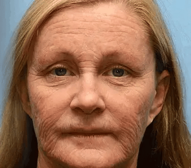 👨‍⚕️Made and Shipped from Australia✅ Furzero™ Botox Bee Venom Wrinkle Removal Cream- LAST DAY 70% OFF